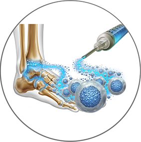 Regenerative foot treatment